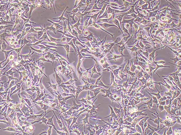 92-1人葡萄膜黑色素瘤