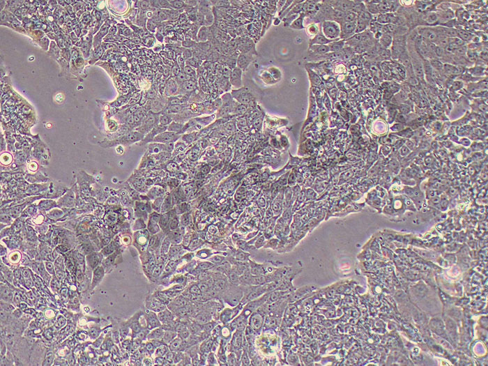 DPC-X1人混合型壶腹癌细胞（STR鉴定正确）