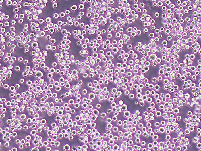 Karpas-299人间变性大细胞淋巴瘤细胞（STR鉴定正确）